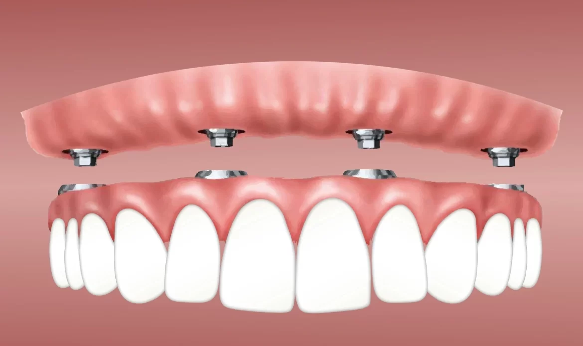 İmplant Nedir? Nasıl Yapılır? Nelere Dikkat Edilmeli?