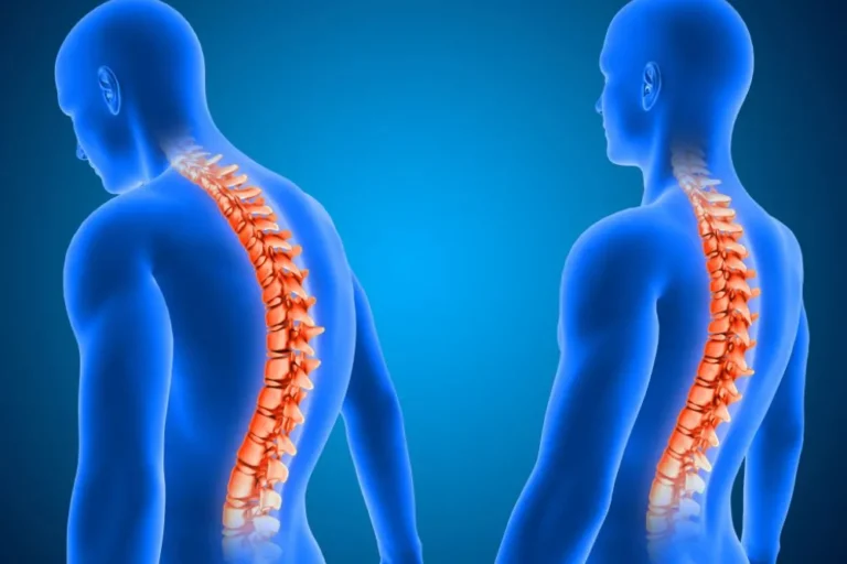 Bel Fıtığı Ameliyatı Sonrası Rehabilitasyon ve İyileşme Süreci