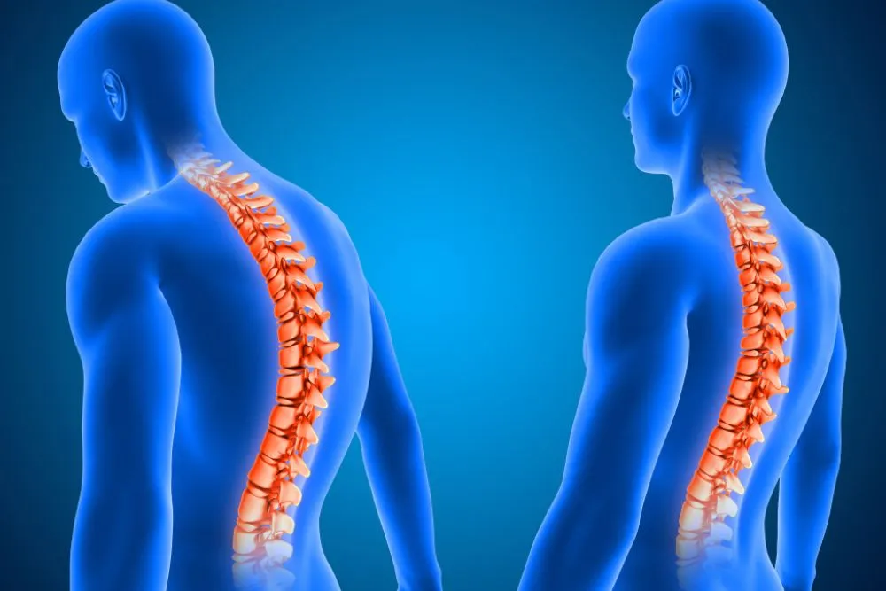 Bel Fıtığı Ameliyatı Sonrası Rehabilitasyon ve İyileşme Süreci
